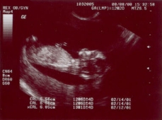 Echographie 2D
